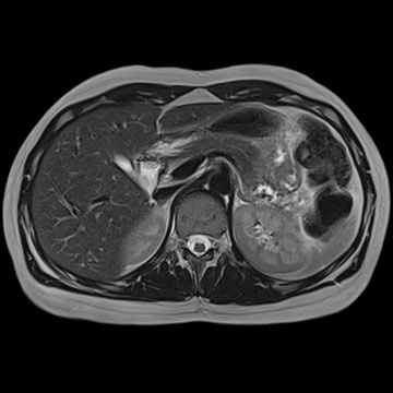 MRI Abdomen