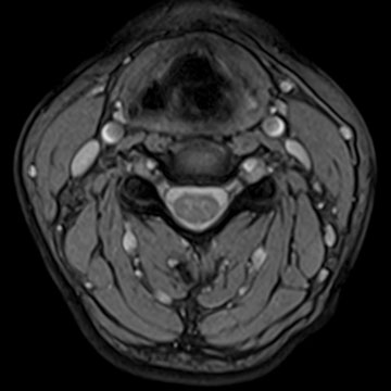 MRI c-spine