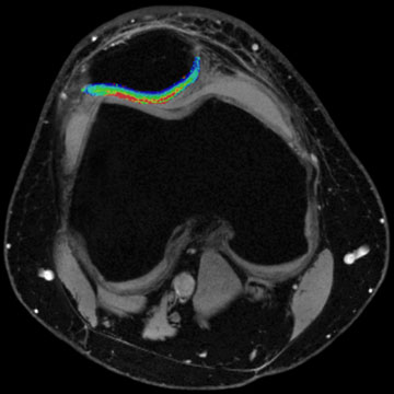 MRI knee