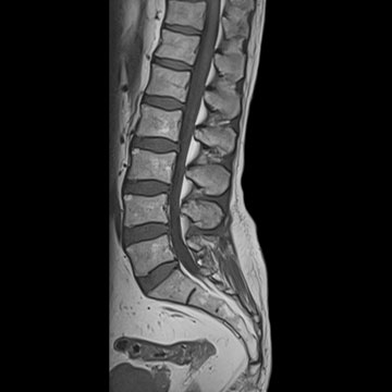 MRI l-spine