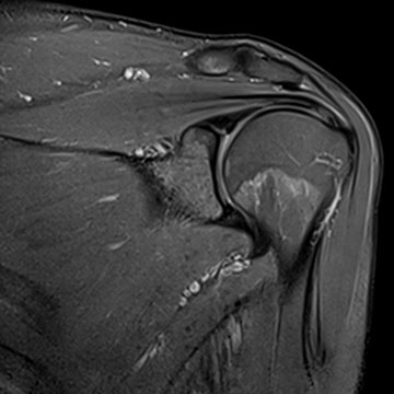 MRI shoulder