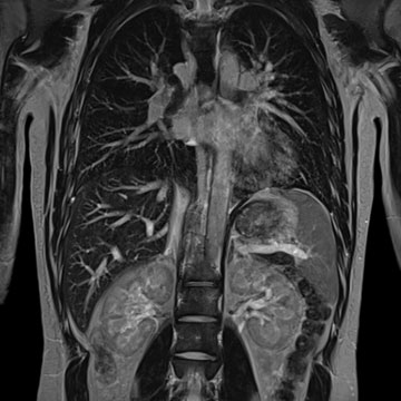 MRI thorax abdomen